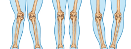 Kireçlenmelerde Diz Çevresi Osteotomileri